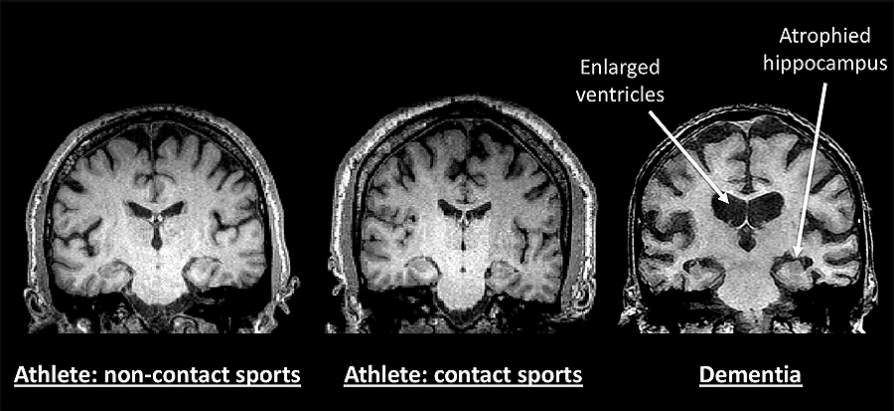 Comprehensive study of 21 retired NFL and NHL players doesn't find evidence of early onset dementia Image